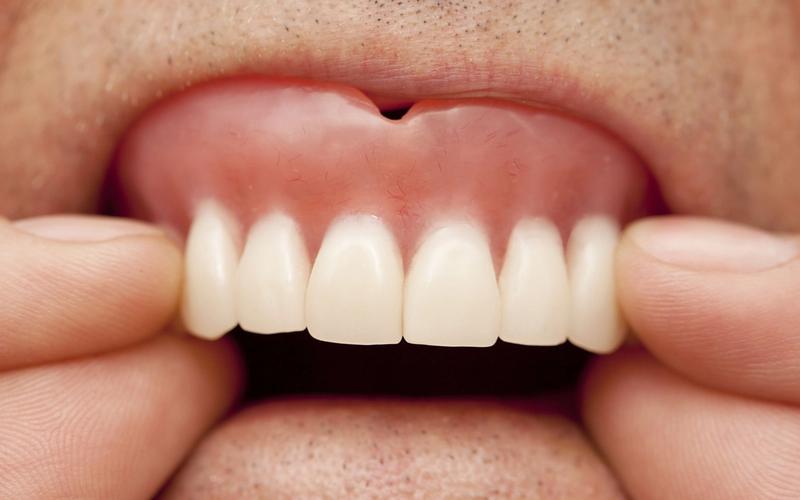 Signs Your Dentures Need to Be Replaced
