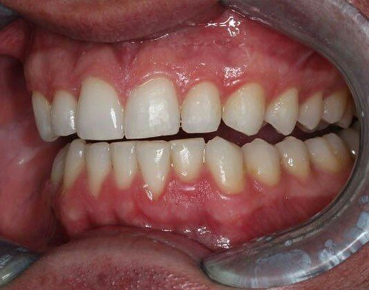 Case 1 After Invisalign