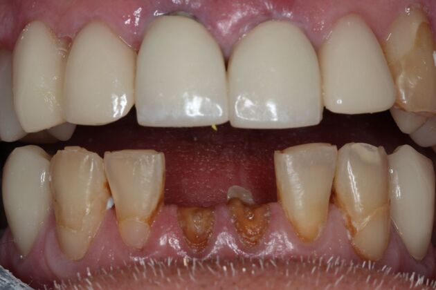 Teeth in a Day: Case 29 — Before Lower All on 4 / After LowerAll on 4 before