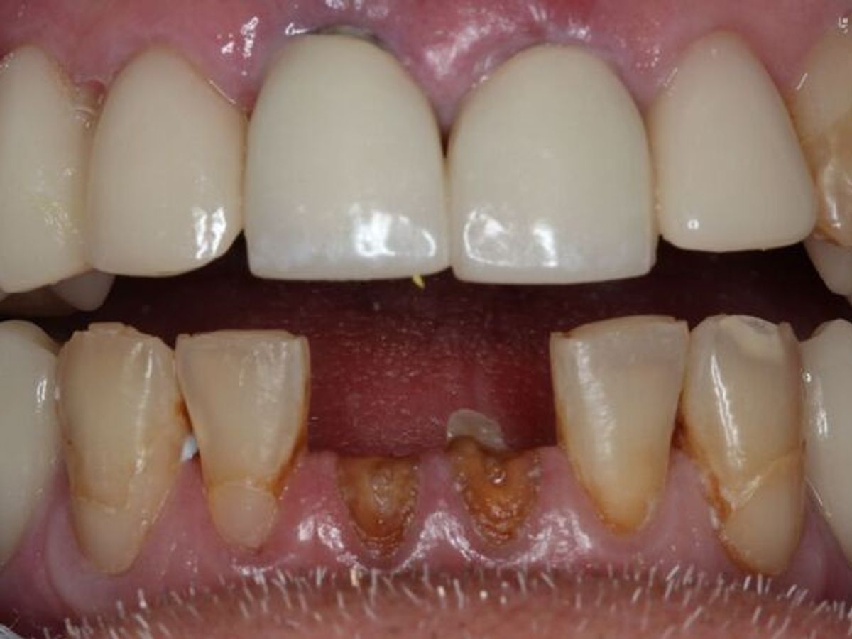 Teeth in a Day: Case 29 — Before Lower All on 4 / After LowerAll on 4 before