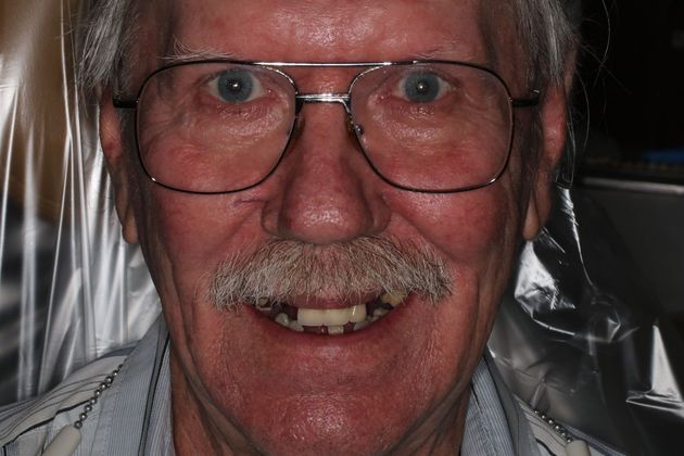 Dentures: Case 10 — before