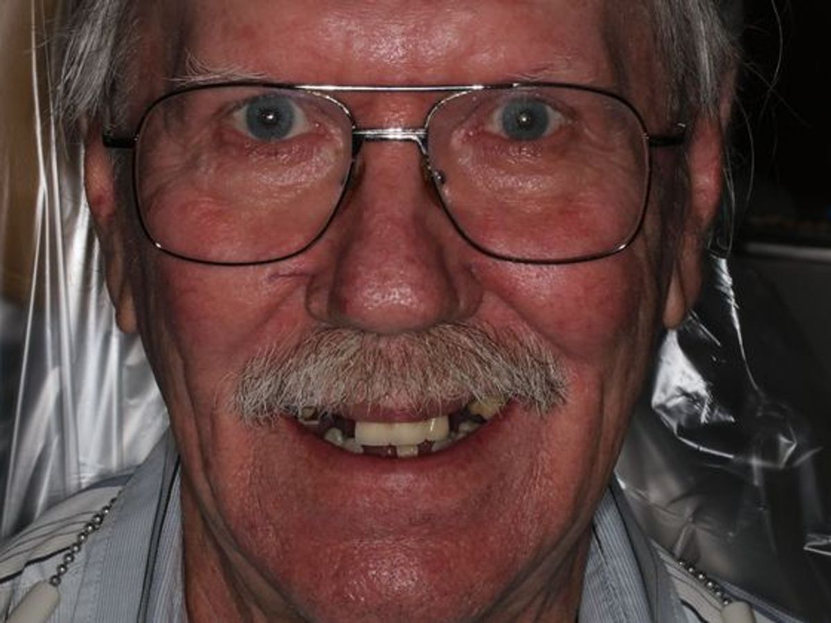 Dentures: Case 10 — before