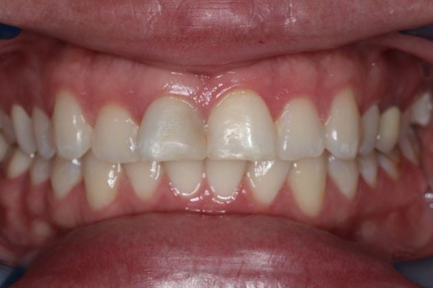 Dental Crowns: Case 5 — before