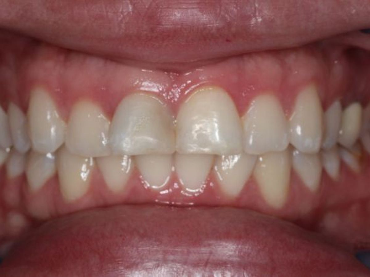 Dental Crowns: Case 5 — before