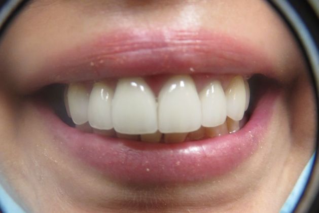 Dental Crowns: Case 7 — after