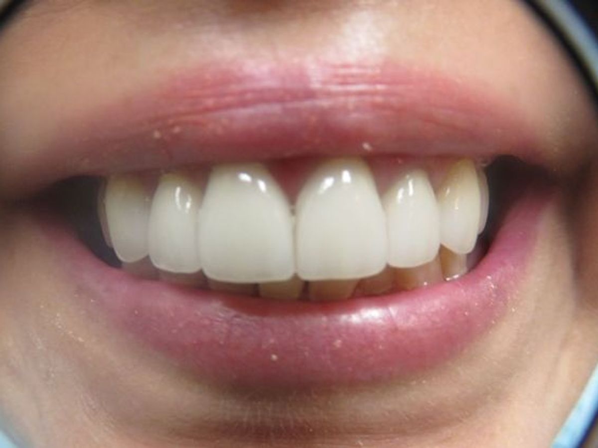 Dental Crowns: Case 7 — after