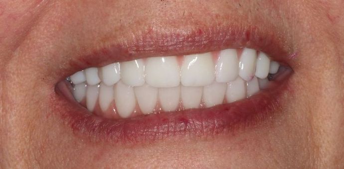 Teeth in a Day: Case 7 — after