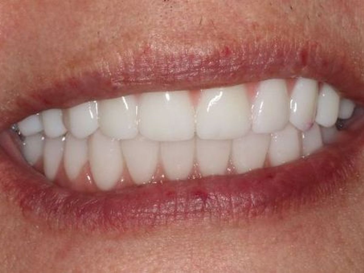 Teeth in a Day: Case 7 — after