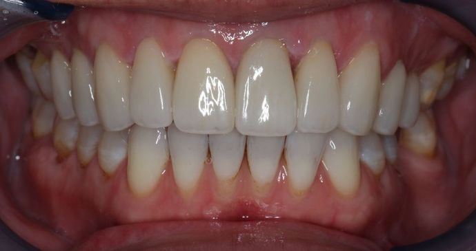 Veneers: Case 5 — after