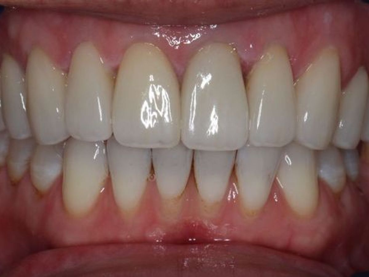 Veneers: Case 5 — after