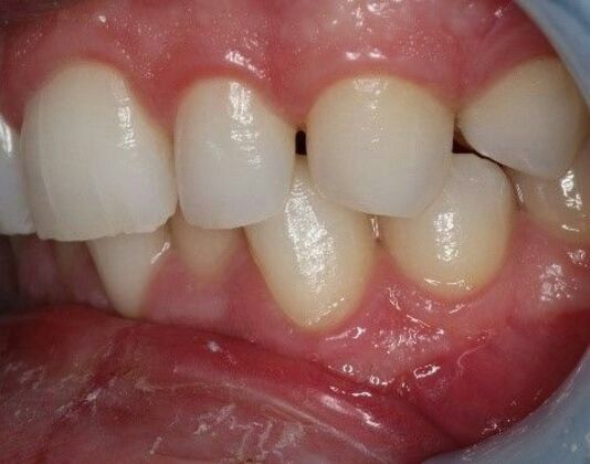 Case 1 Before Invisalign