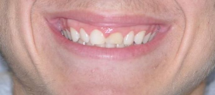 Gum Lift: Case 4 — before
