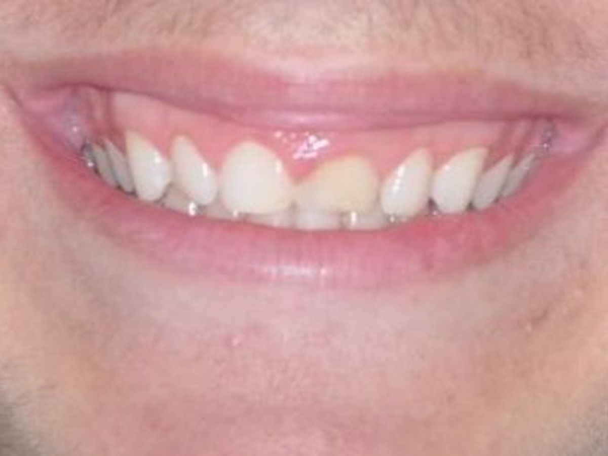 Gum Lift: Case 4 — before