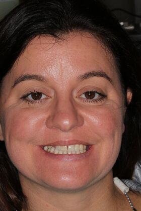 Veneers: Case 23 — before
