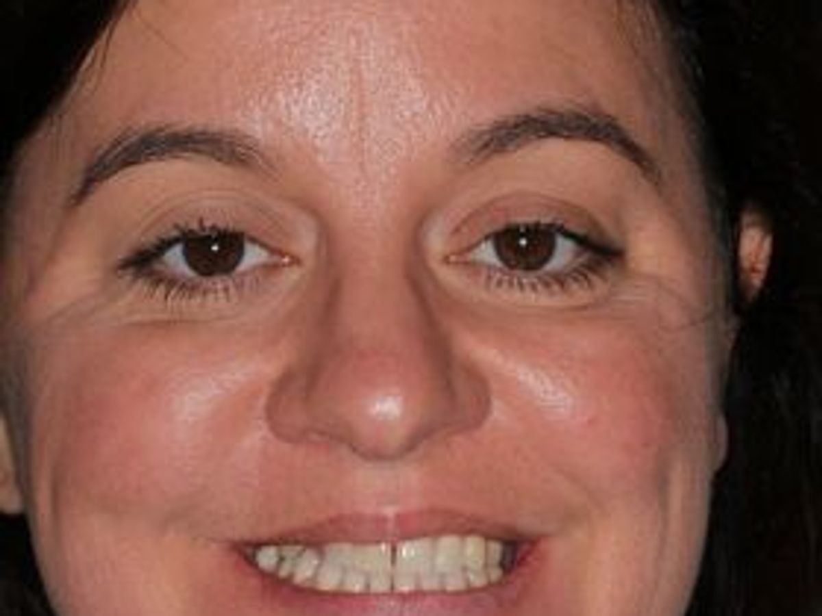 Veneers: Case 23 — before
