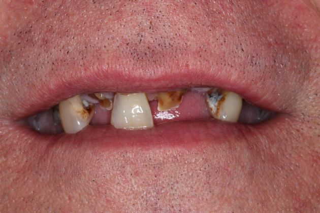 Dentures: Case 3 — before