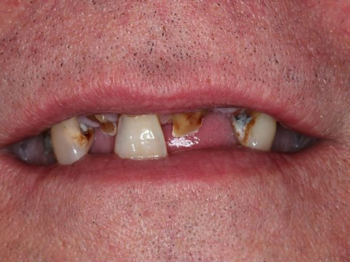 Dentures: Case 3 — before