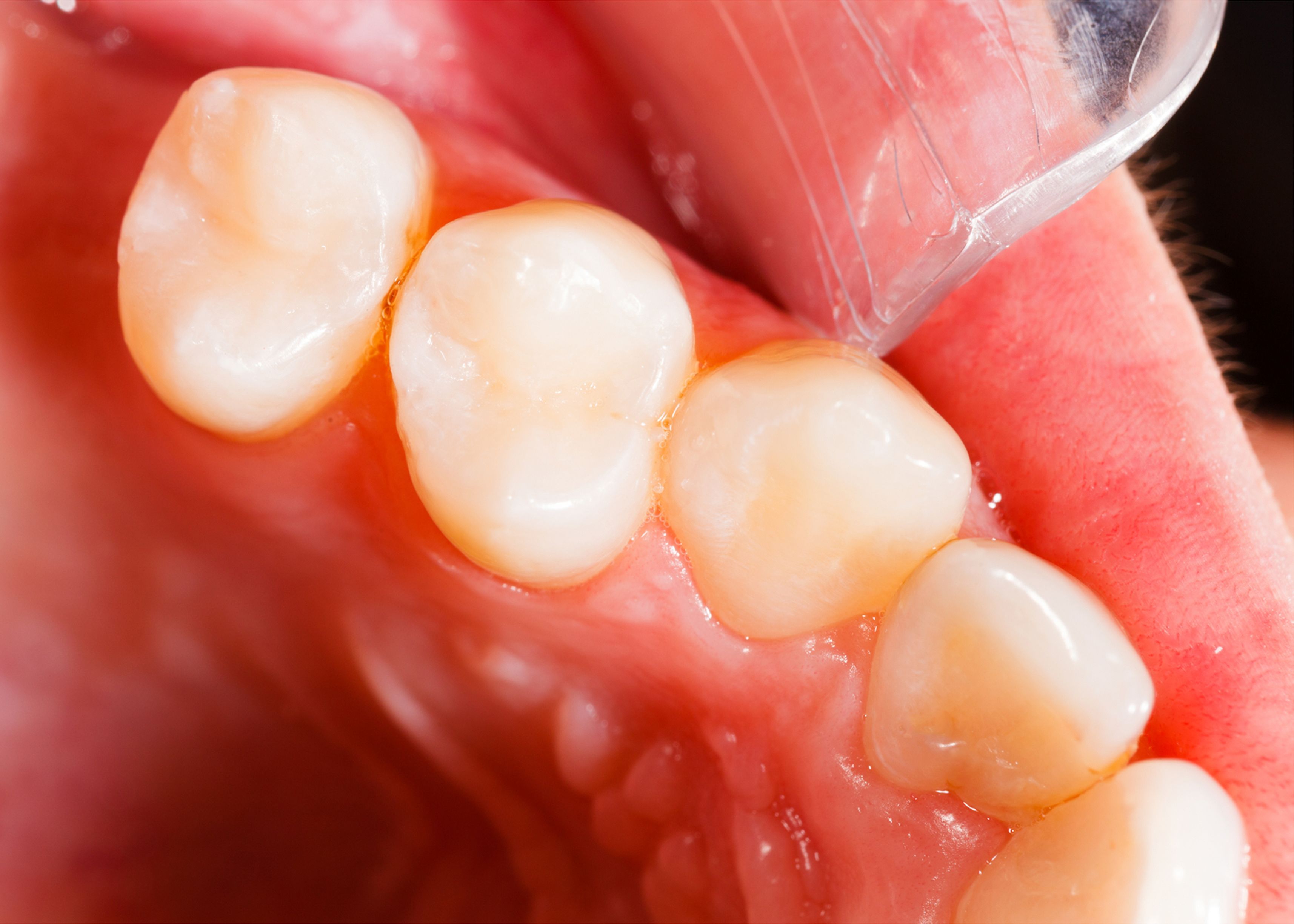 Close-up of tooth with a tooth-colored filling