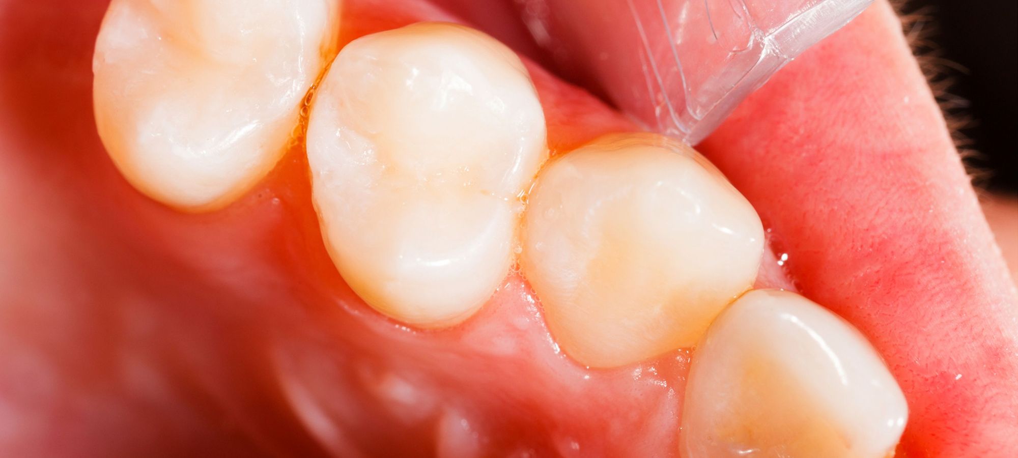 Close-up of tooth with a tooth-colored filling