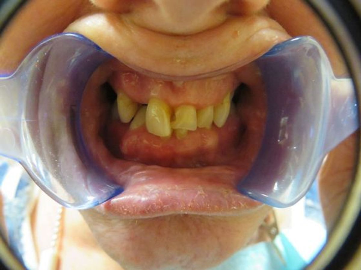Teeth in a Day: Case 1 — before