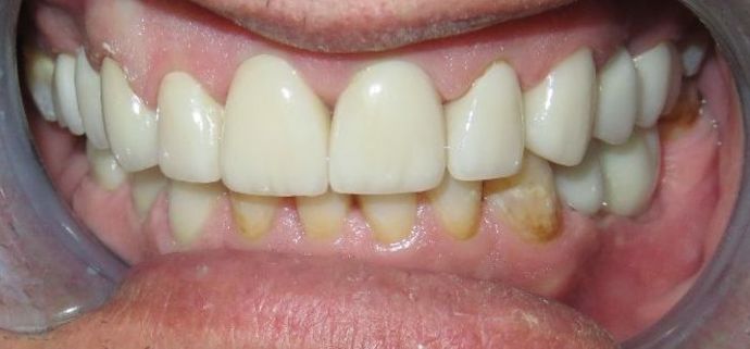 Dental Crowns: Case 21 — after