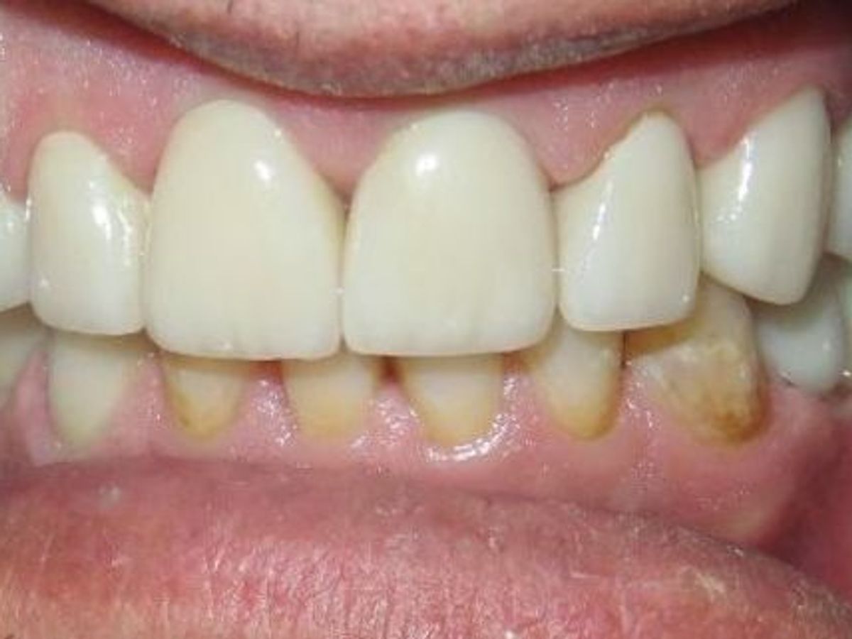 Dental Crowns: Case 21 — after