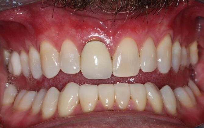 Veneers: Case 24 — After Lower Veneers after