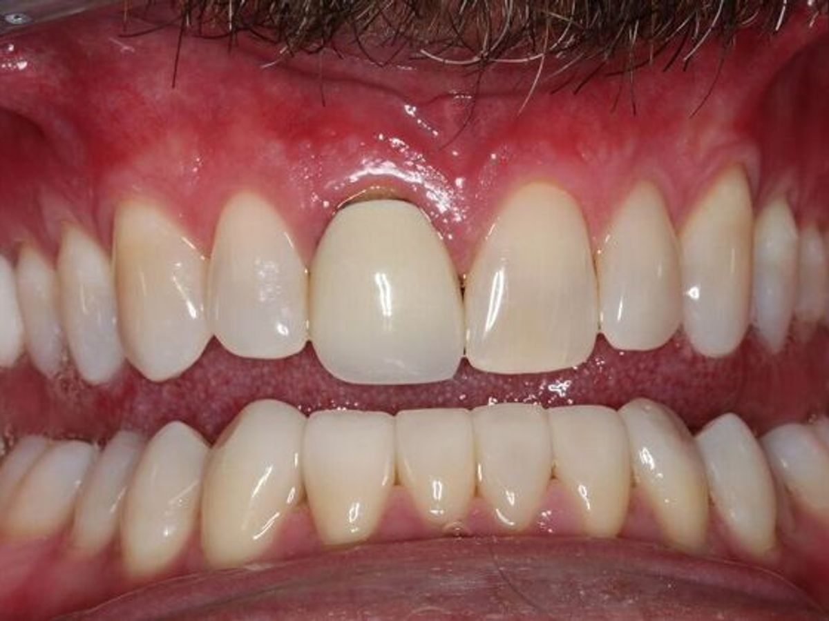 Veneers: Case 24 — After Lower Veneers after