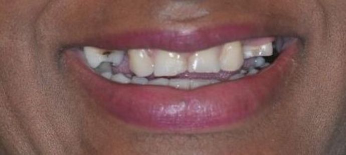 Dental Crowns: Case 16 — before