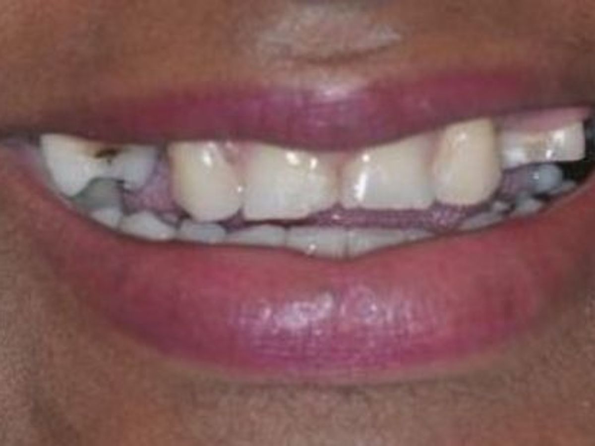 Dental Crowns: Case 16 — before
