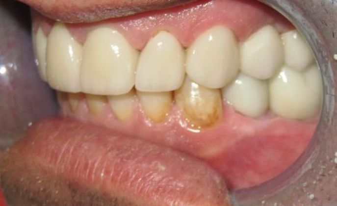 Dental Implants: Case 2 — after