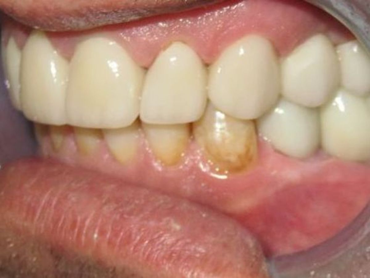 Dental Implants: Case 2 — after