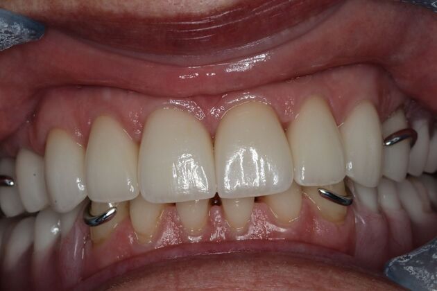 Dental Crowns: Case 33 — Top Crowns with Partial Denture after