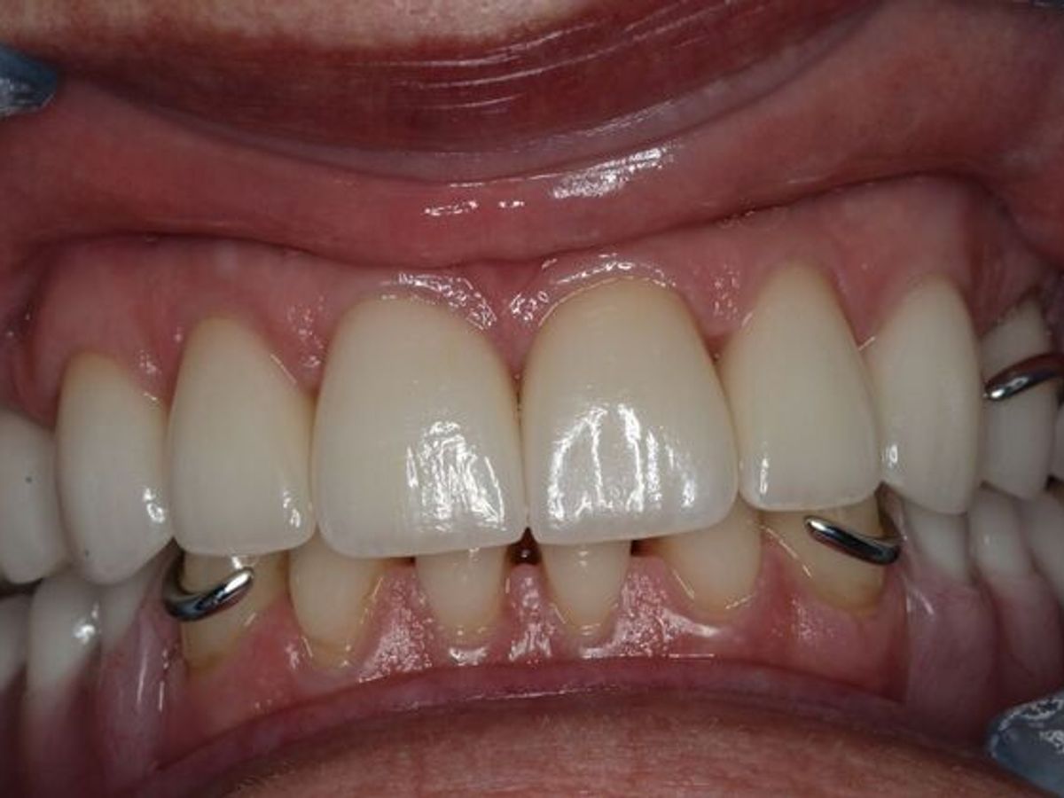 Dental Crowns: Case 33 — Top Crowns with Partial Denture after