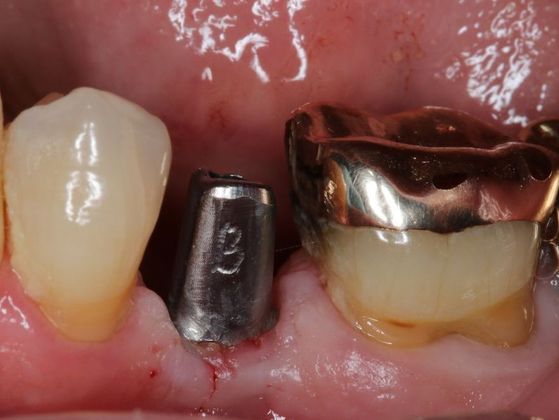 Dental Implants: Case 4 — before