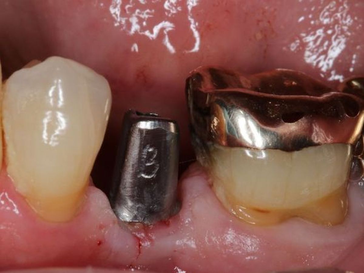 Dental Implants: Case 4 — before