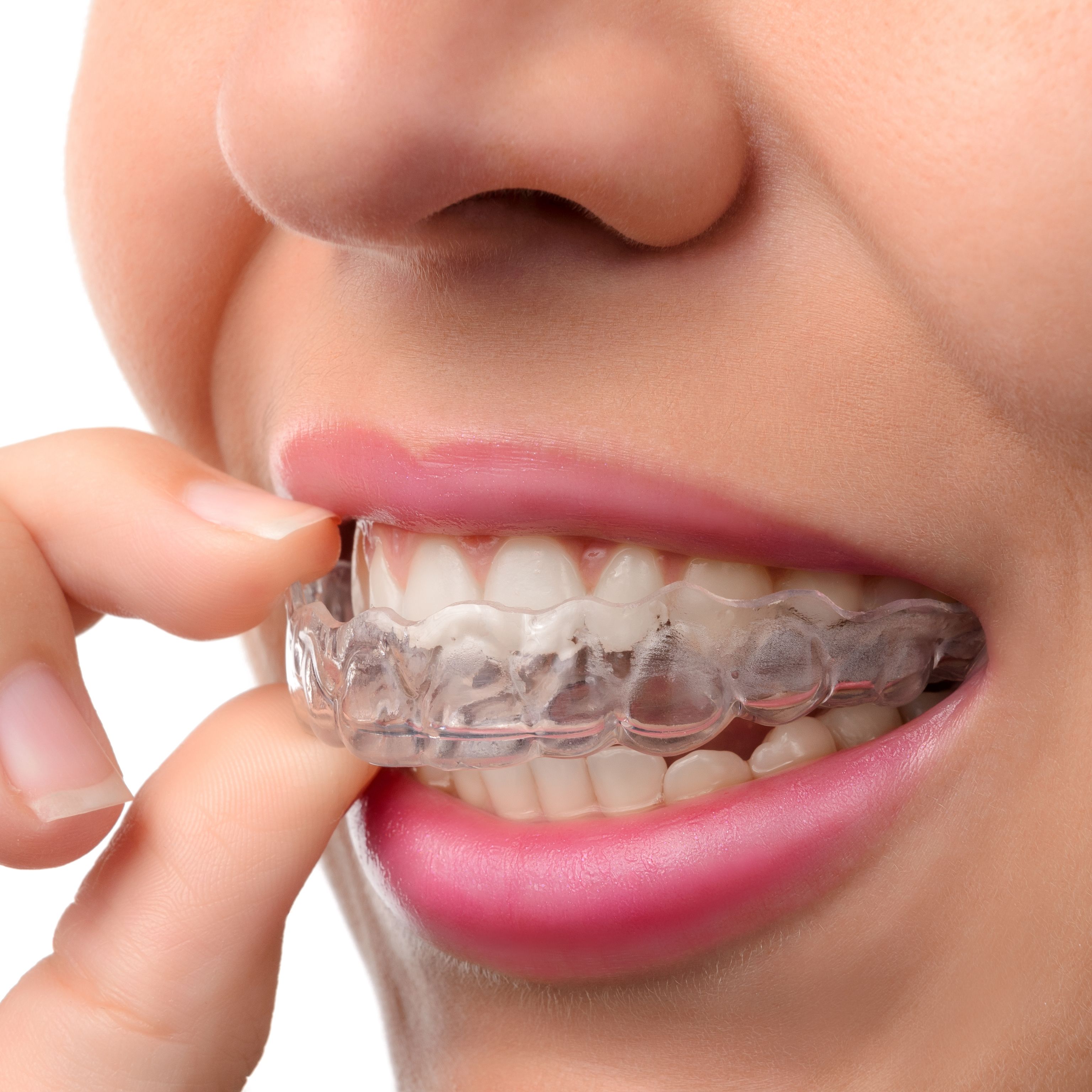 How Invisalign Is Used to Treat Overbites