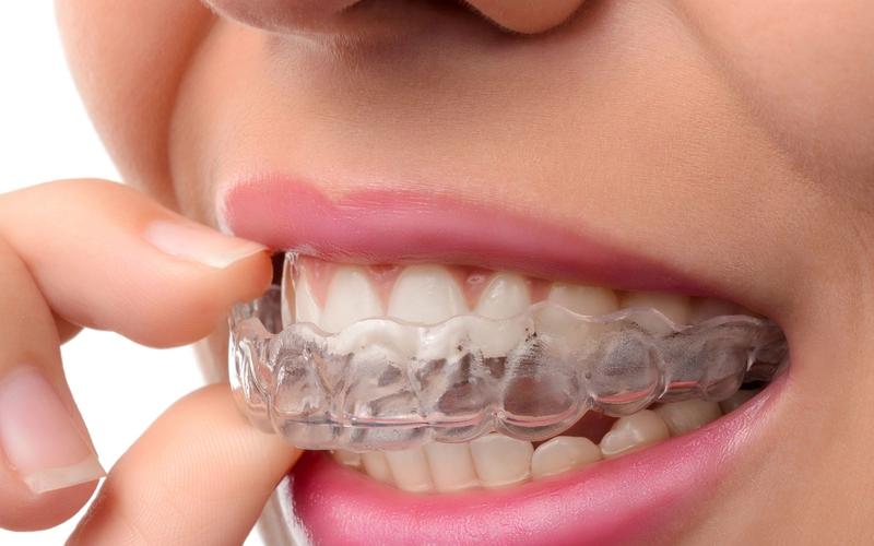 How Invisalign Is Used to Treat Overbites