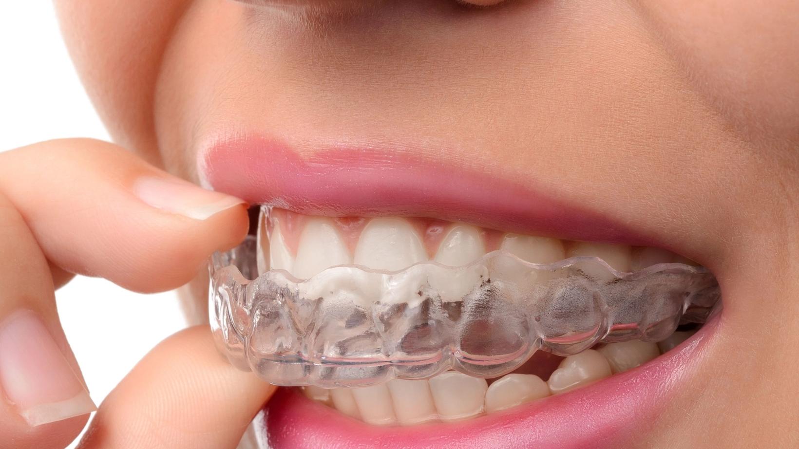 How Invisalign Is Used to Treat Overbites