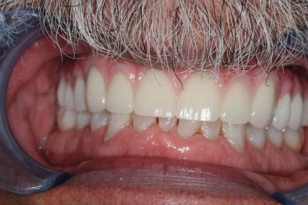 Teeth in a Day: Case 3 — Upper Arch before