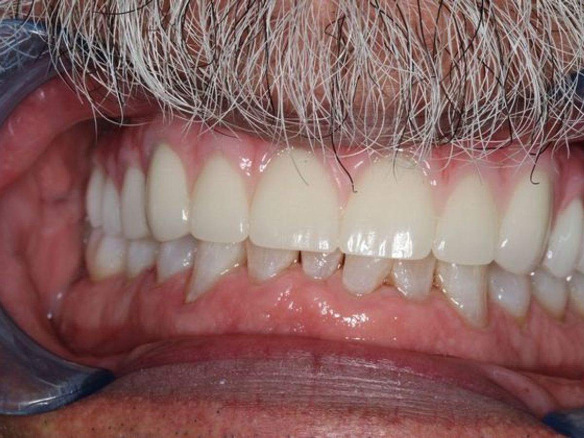 Teeth in a Day: Case 3 — Upper Arch before