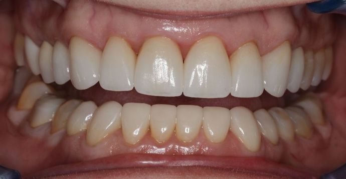 Veneers: Case 13 — after