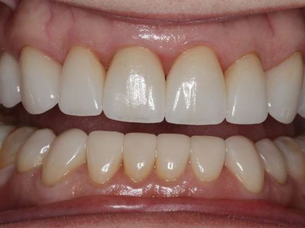 Veneers: Case 13 — after