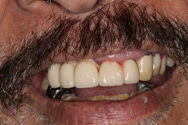 Teeth in a Day: Case 25 — Upper All on 4 and Lower Crowns before