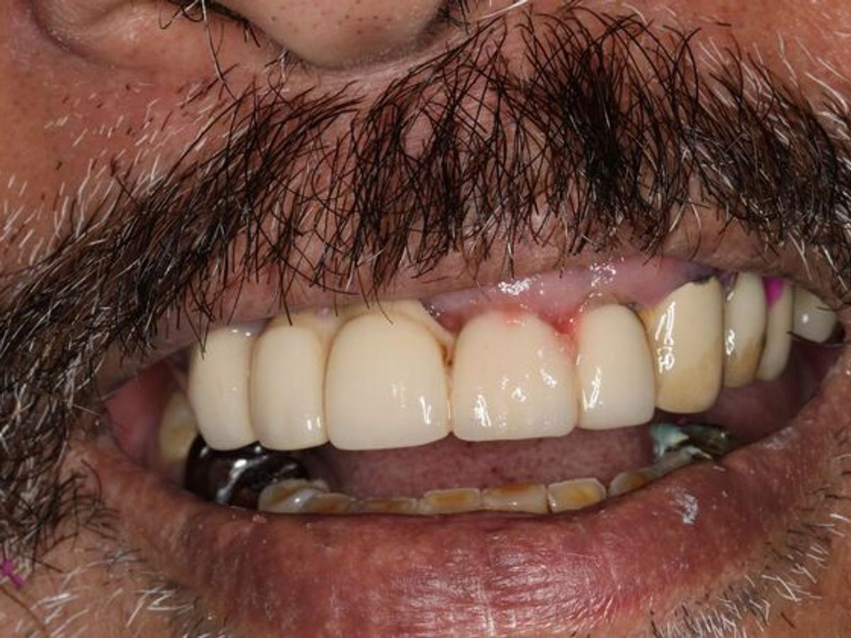 Teeth in a Day: Case 25 — Upper All on 4 and Lower Crowns before