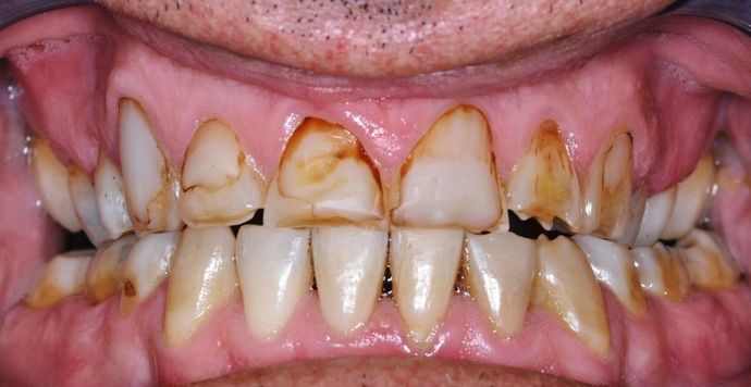 Dental Crowns: Case 11 — before