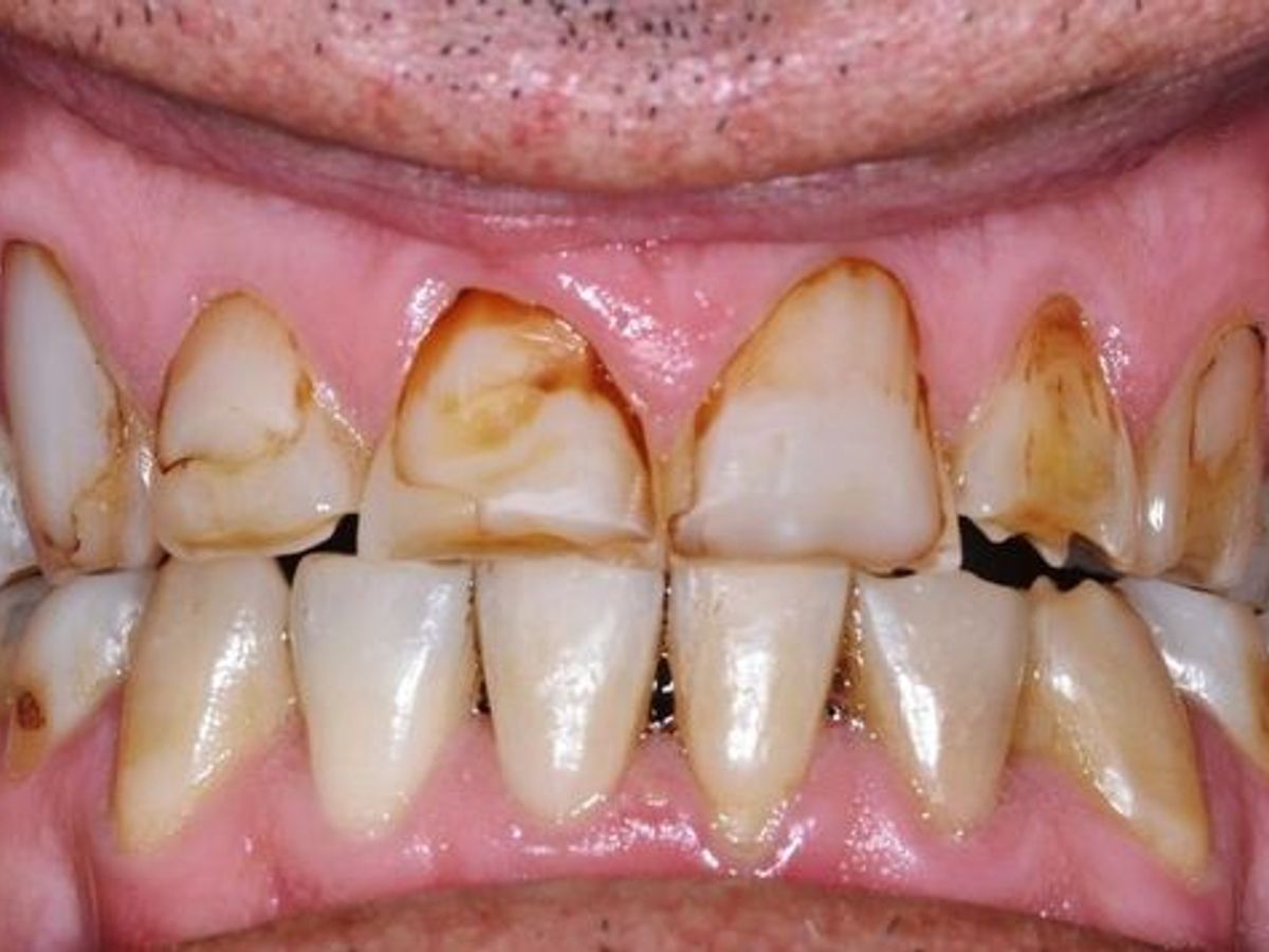 Dental Crowns: Case 11 — before