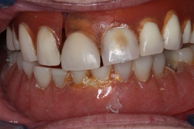 Teeth in a Day: Case 30 — before