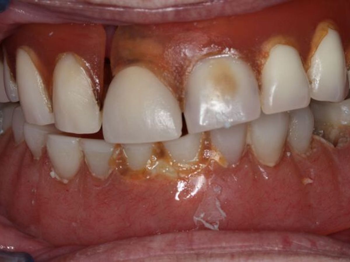 Teeth in a Day: Case 30 — before