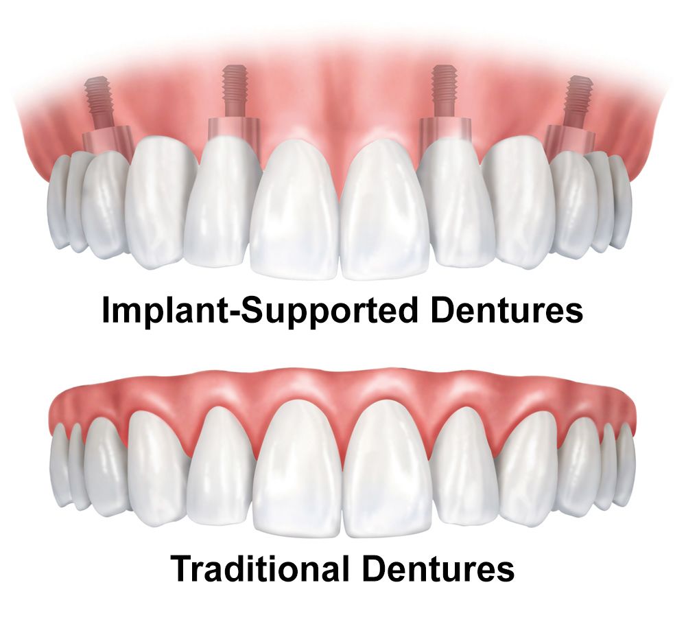 Traditional vs. Implant-supported Dentures